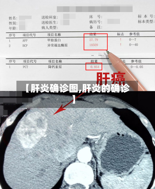 【肝炎确诊图,肝炎的确诊】