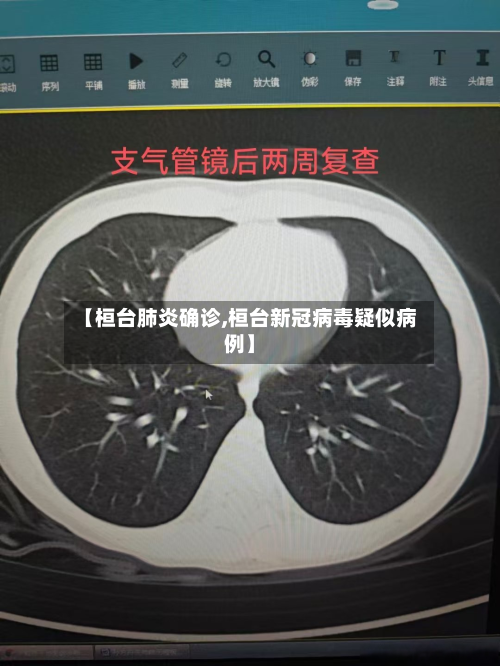 【桓台肺炎确诊,桓台新冠病毒疑似病例】