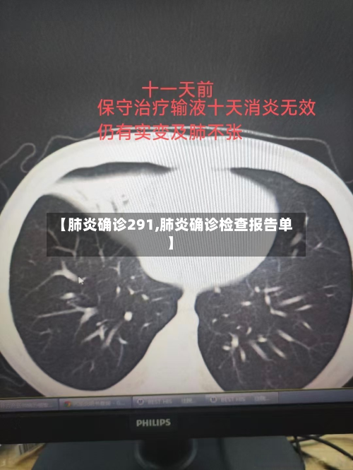 【肺炎确诊291,肺炎确诊检查报告单】