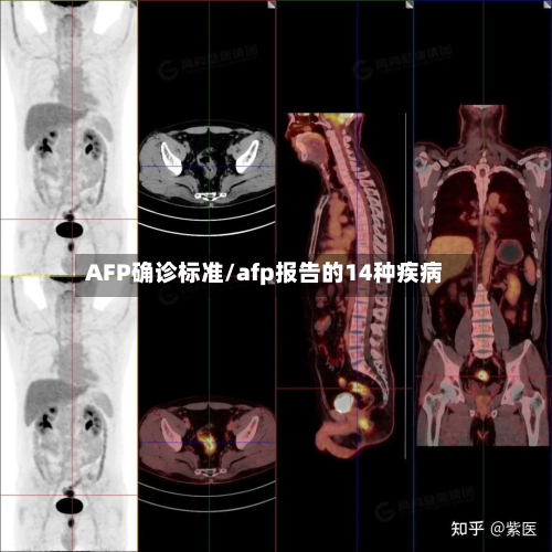AFP确诊标准/afp报告的14种疾病-第2张图片