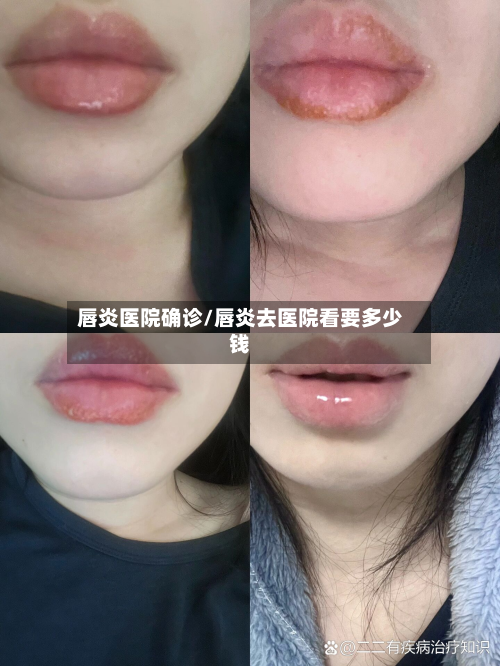 唇炎医院确诊/唇炎去医院看要多少钱-第3张图片