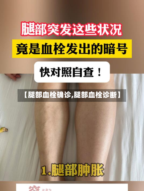 【腿部血栓确诊,腿部血栓诊断】