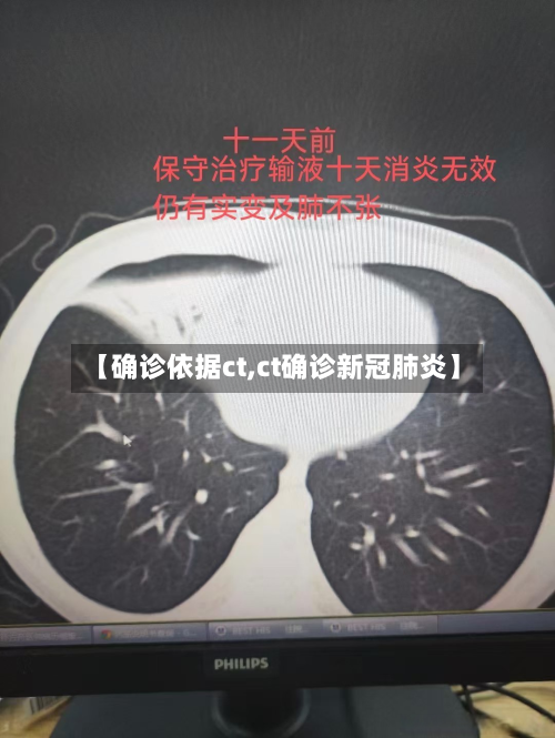 【确诊依据ct,ct确诊新冠肺炎】-第2张图片