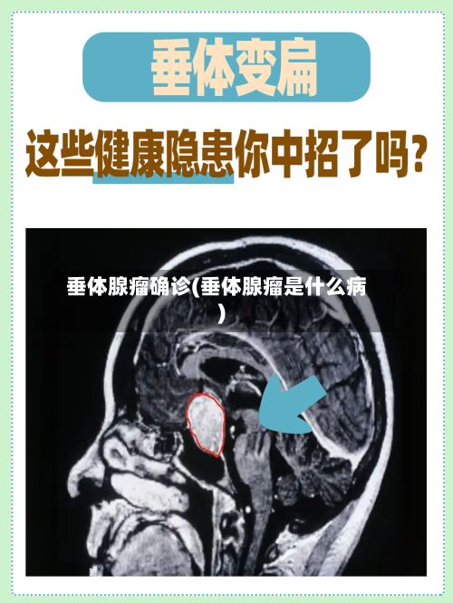 垂体腺瘤确诊(垂体腺瘤是什么病)