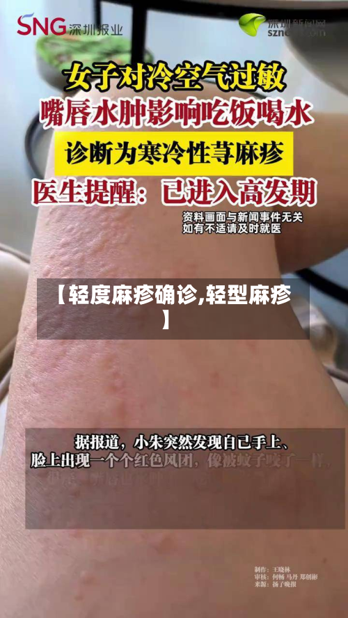 【轻度麻疹确诊,轻型麻疹】-第2张图片